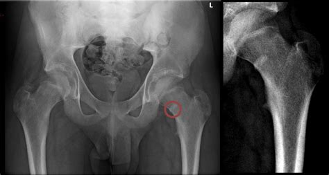 Lesser Trochanter Avulsion Fracture In An Adolescent After Seizure