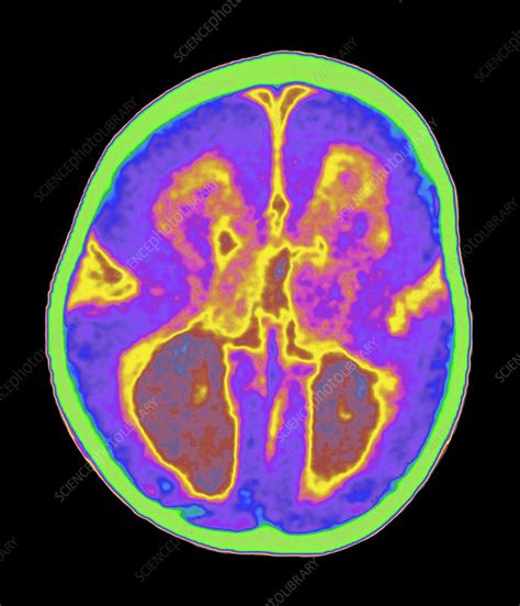 Coloured Mri Brain Scan Showing Lissencephaly Stock Image M2000142