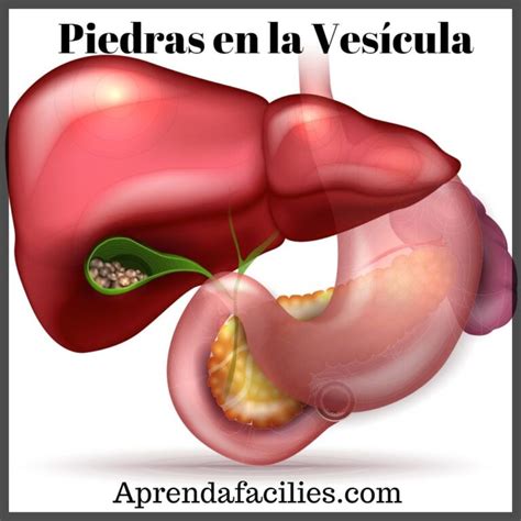 Piedras En La Vesicula Biliar Causas Y Tratamiento Aprendafaciles Images Hot Sex Picture