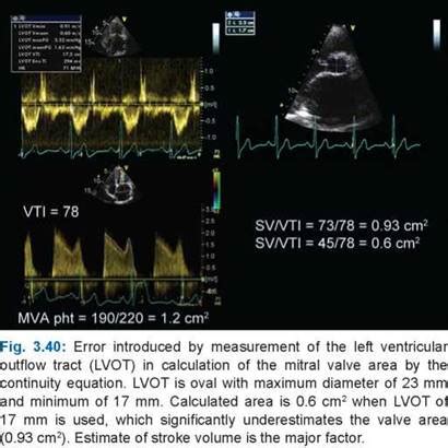 Mitral Stenosis A Practical Approach To Clinical Echocardiography 1st