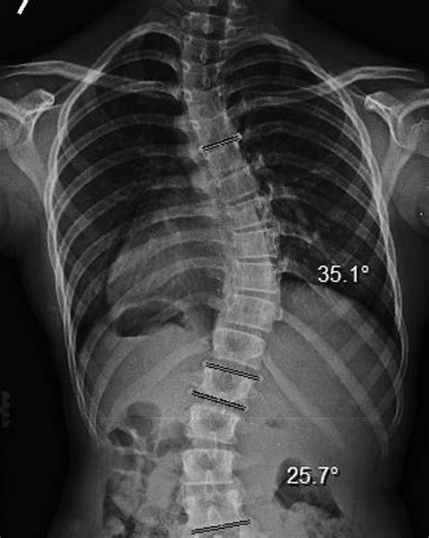 Spinal Technology Types Of Scoliosis