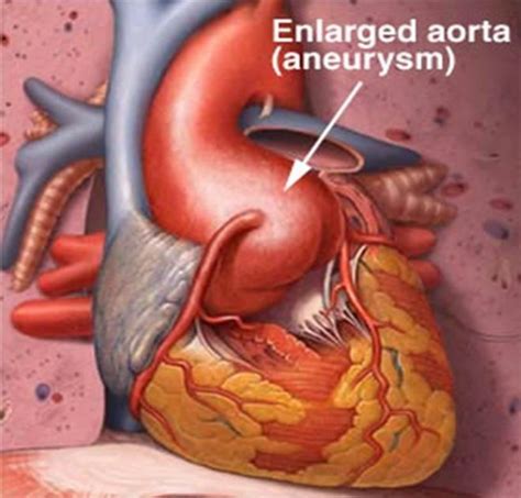Enlarged Aorta Symptoms Treatment Surgery Pictures