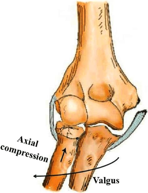 Radial Head Fractures With Avulsion Of The Medial Collateral Ligament