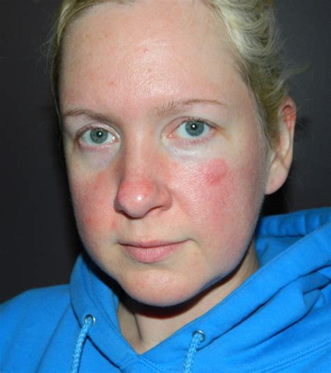 Living With Rosacea And Eczema Beautyjudy