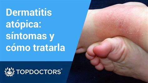 Tratamiento Recomendado Para La Dermatitis Atópica 55 Youtube