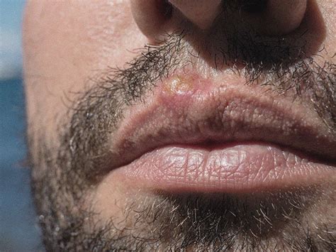 blister on lower lip