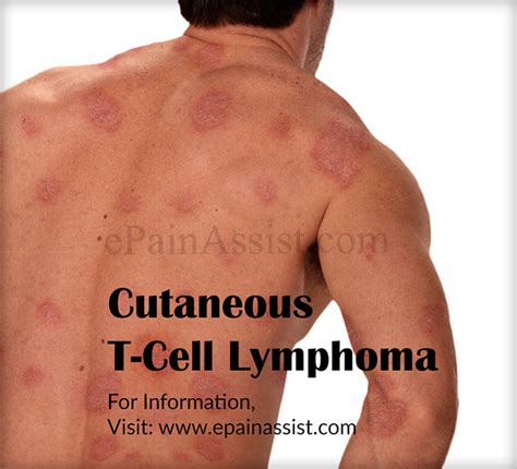 What Is Ctcl Or Cutaneous T Cell Lymphomacausessymptomsstagesdiagnosis