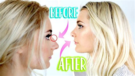 Make sure to subscribe & turn on notifications so you don't miss my nose surgery video next week! NOSE JOB UPDATE ONE YEAR LATER! Was it Worth It?! - YouTube