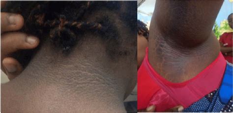 Acanthosis Nigricans On The Nape Of Neck And Armpit Download