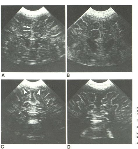 Figure 1 From Sonographic Findings In Infants With Macrocrania 307