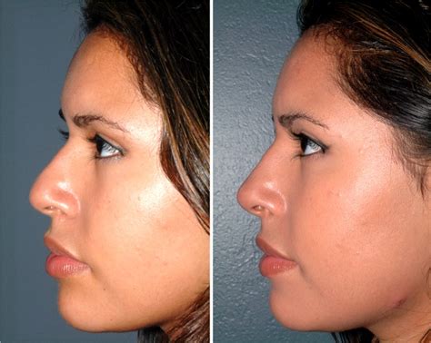 What Is A Non Surgical Nose Job Lasting Looks Clinic