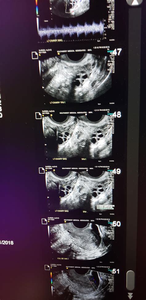 Had A Pelvic Ultrasound Done Today And Took Pictures Of The Screen When