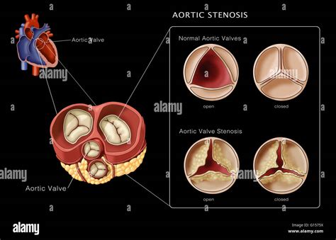Illustration De Valves Aortiques Normale Par Rapport à Une Sténose