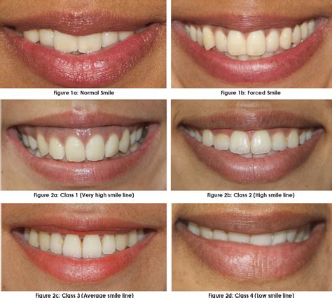 Pdf Evaluation Of Smile Line In Natural And Forced Smile Position An