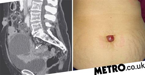 Painful Growth In Womans Belly Button Was A Sign Of Ovarian Cancer