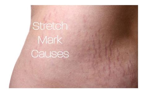 What Causes Stretch Marks On The Skin Natural Cleanse Review