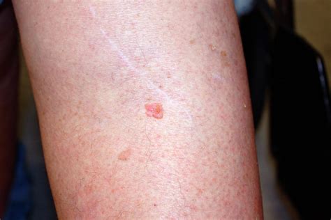 Squamous Cell Carcinoma On A Leg Photograph By National Cancer Institute Science Photo Library