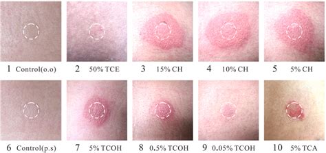 Results Of The Skin Patch Test The White Circle Represents The