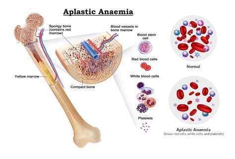 Aplastic Anaemia Sign And Symptoms Causes Risk Factors Diagnosis