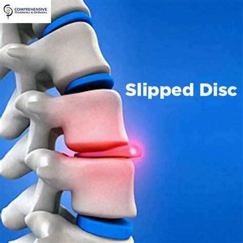 Slipped Disc Types Causes Risk And Symptoms Explained