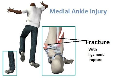 This grade of injury takes about 3 weeks to heal completely. Physiotherapy - ReLiva Physiotherapy & Rehab
