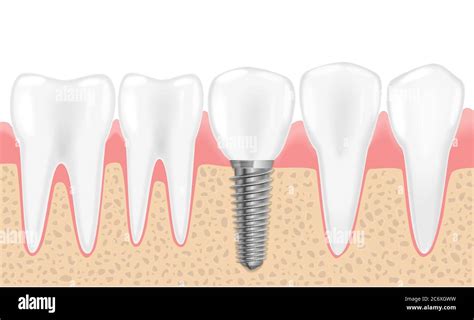 Dientes Sanos E Implante Dental Ilustración Vectorial Realista De La