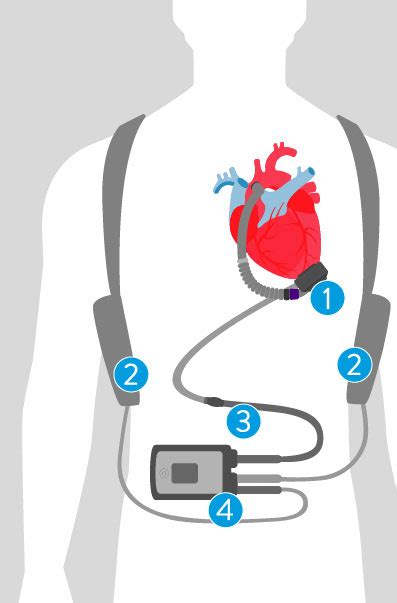 Diagram Of The Heartmate 3 Lvad System On An Outline Of A Person