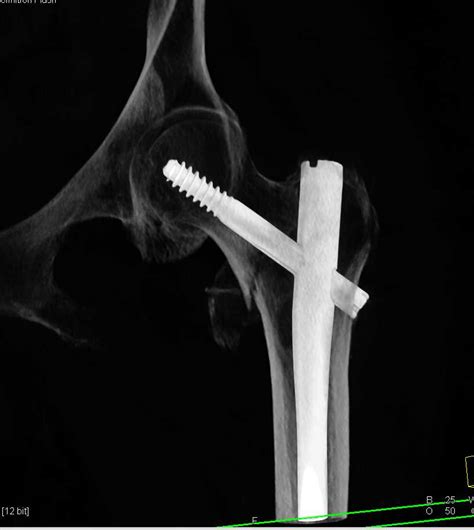 Femur Fracture With Rod In Place Musculoskeletal Case Studies