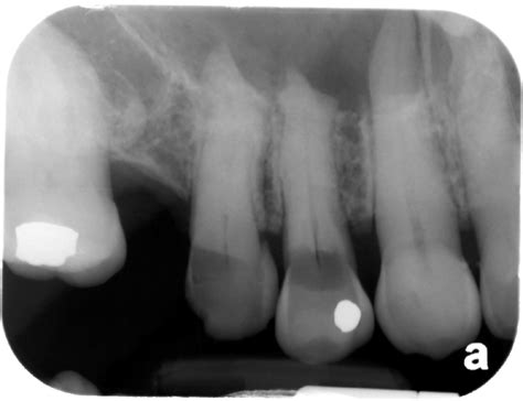 Case Of The Week Radicular Cyst Dr Gs Toothpix