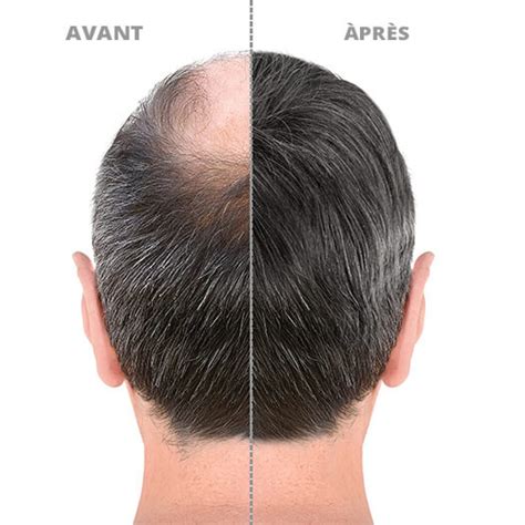 Greffe de cheveux chez l'homme et la femme - Docteur Daniel Meunier