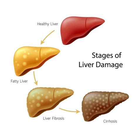 10 Signs Of Liver Damage Facty Health