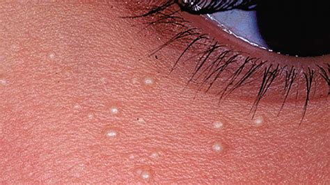 The condition result in white patches that can appear on the face, the upper part of the back, on shins and arms. White Spots on Face: What's Causing It?