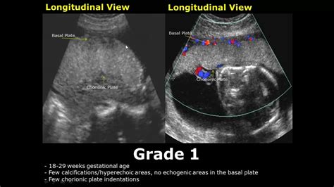 Placental Grading On Ultrasound Grade 0 1 2 3 Placenta USG YouTube