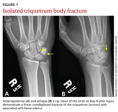 20 Year Old Male College Basketball Prospect Wrist Pain After Falling