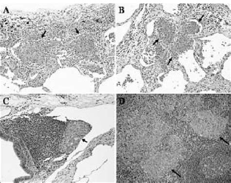 Noncaseating Epithelioid Cell Granulomas Of Lung And Lymphnode Tissue