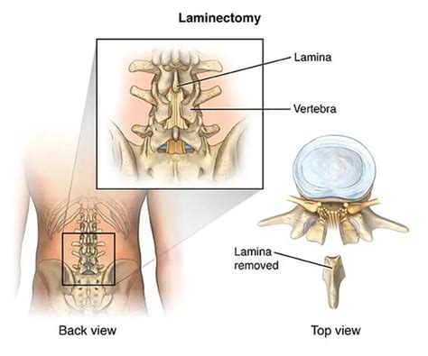 Discectomy Vs Laminectomy What’s The Difference