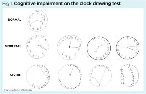 Bottom left, clock with a failed. Assessment of older people 4: assessing the psychological ...