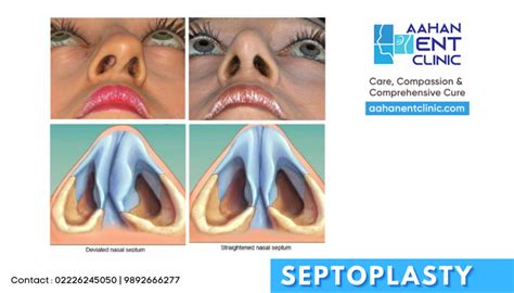 Deviated Nasal Septum And Septoplasty What You Need To Know Aahan Ent Clinic Drajay Doiphode