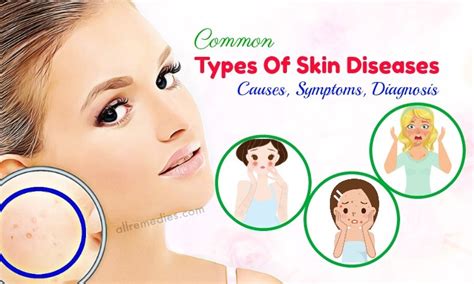 Top 7 Common Types Of Skin Diseases Causes Symptoms Diagnosis