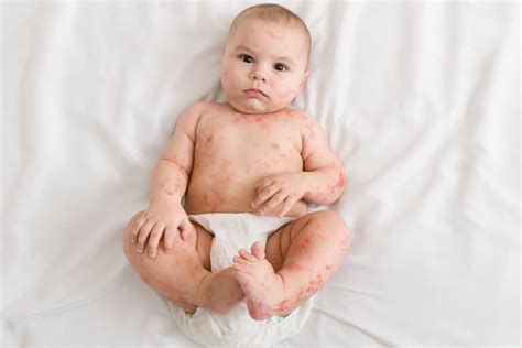 Viral Rashes In Babies Types Symptoms And Treatment Being The Parent