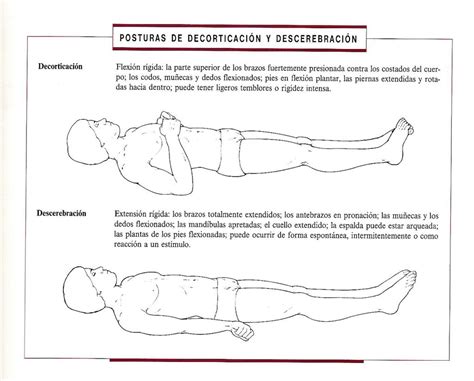 DECORTICACION Y DESCEREBRACION PDF Los brazos están doblados hacia el cuerpo y.
