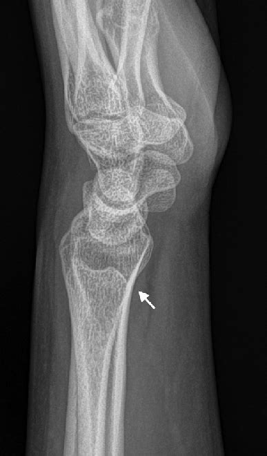 Left Wrist Radiograph Lateral View Showing Reduction Of The Displaced