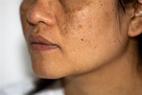 Skin Treatment Clinic In Pitampura Rohini Delhi Vardaan Clinic