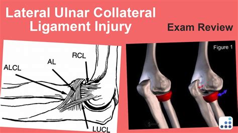 Ulnar Collateral Ligament Injury And Reconstruction Ons Sexiezpicz