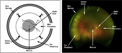 Lesson Peripheral Retinal Imaging And Disease Assessment