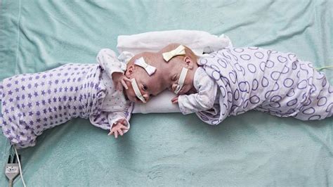 Conjoined Twins Separated Successfully At 10 Months Old Au