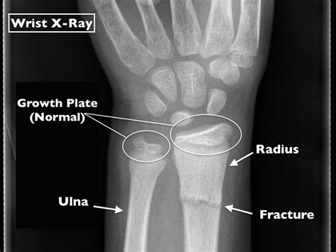 Skeletal Trauma And Signs Of Child Abuse In Pediatric Imaging