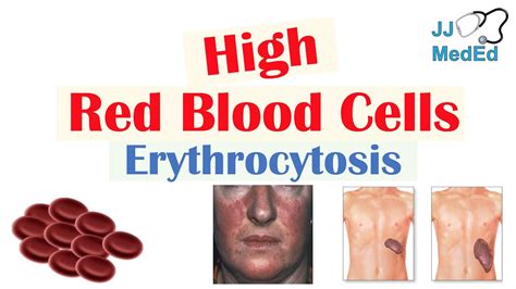 High Red Blood Cells Erythrocytosis Causes Signs And Symptoms And