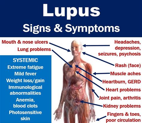 Early Warning Signs Of Lupus You Need To Know Warning Signs Body My