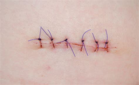 History Of Sutures Health Beat